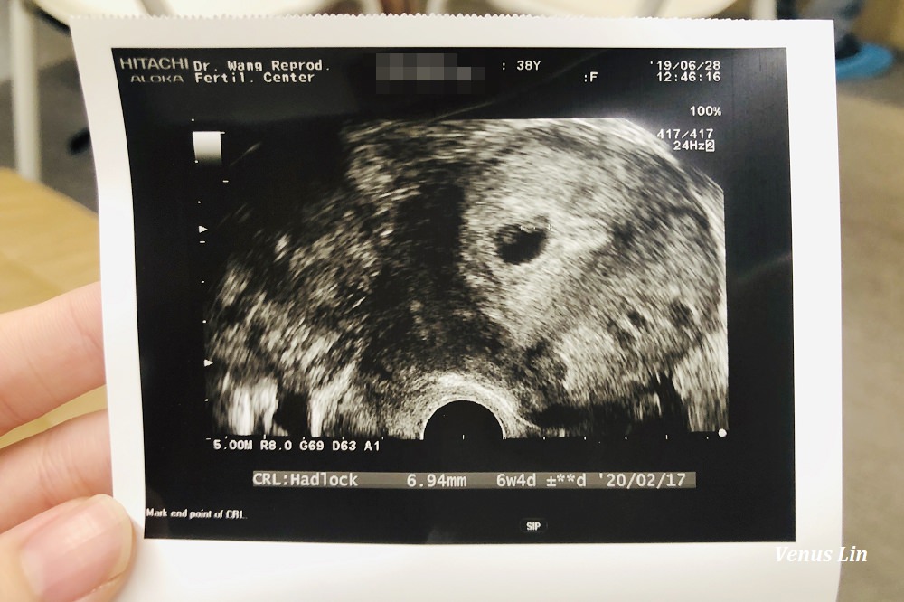 懷孕6週 照到心跳了 又出血 正好是王家瑋婦產科產檢日 又唉了一針安胎針 購物狂女王venus